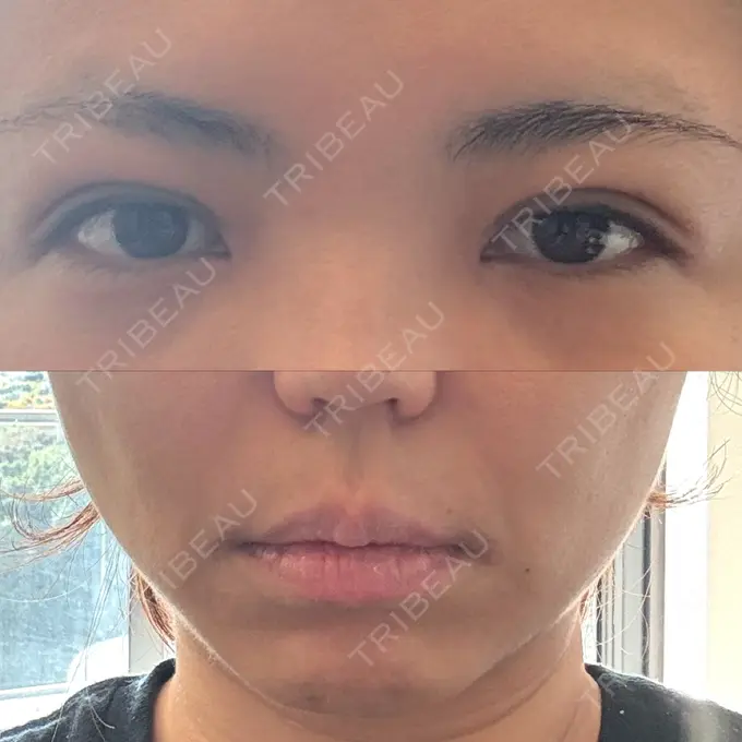 二重埋没 / 目頭切開 / 糸リフト / 鼻翼基部形成（貴族手術） / ヒアルロン酸注入（鼻翼基部） 東京シンデレラ美容外科 池袋院 DAY 13 メイン用