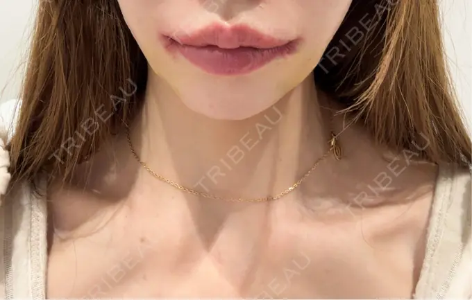 人中短縮 / 口角挙上 R Beauty CLINIC 銀座院 AFTER メイン用