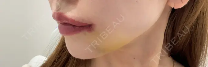 人中短縮 / 口角挙上 R Beauty CLINIC 銀座院 DAY 7 メイン用