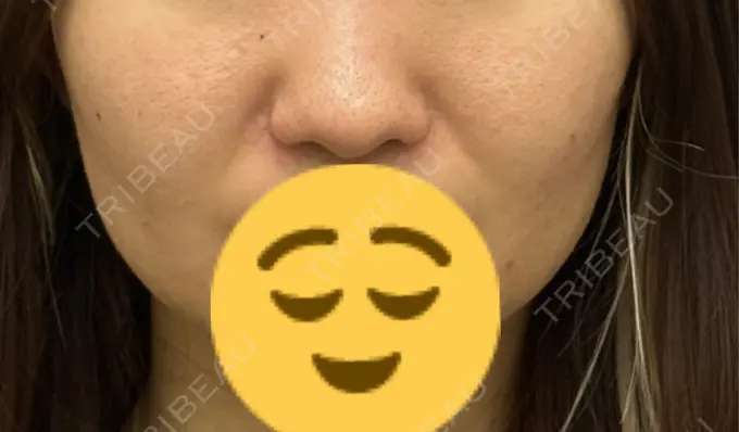 小鼻縮小（切開） 渋谷の森クリニック DAY 77 メイン用