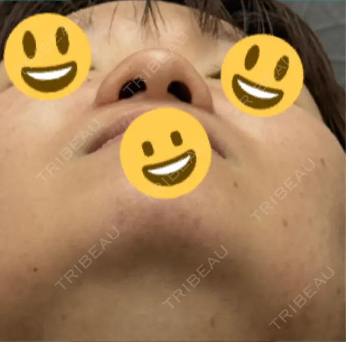 小鼻縮小（切開） 渋谷の森クリニック DAY 77 メイン用