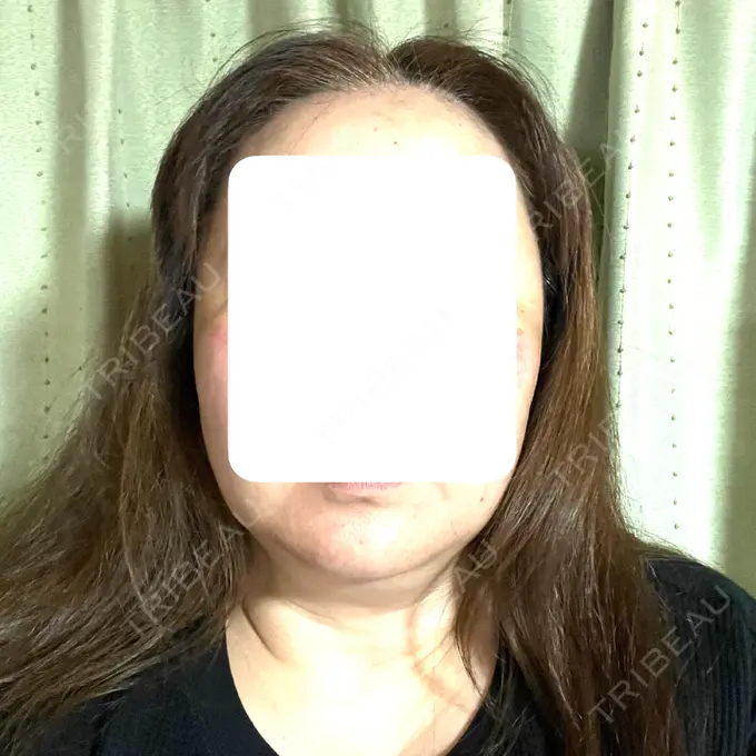 ボトックス（エラ・小顔） / 脂肪溶解注射（顔） / 脂肪溶解注射（お腹） Jfeel（ジェイフィール）クリニック-ホンデ院 DAY 1 メイン用