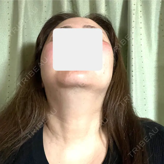 ボトックス（エラ・小顔） / 脂肪溶解注射（顔） / 脂肪溶解注射（お腹） Jfeel（ジェイフィール）クリニック-ホンデ院 DAY 1 メイン用