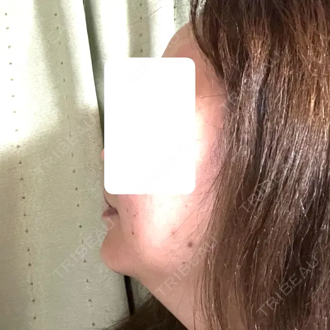 ボトックス（エラ・小顔） / 脂肪溶解注射（顔） / 脂肪溶解注射（お腹） Jfeel（ジェイフィール）クリニック-ホンデ院 DAY 1 メイン用