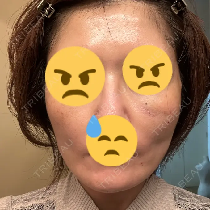 糸リフト SK新宿歌舞伎町美容外科・歯科 DAY 4 メイン用