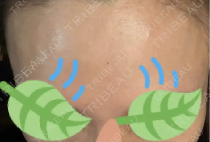 その他（肌） / エレクトロポレーション 品川美容外科 心斎橋院 DAY 2 メイン用