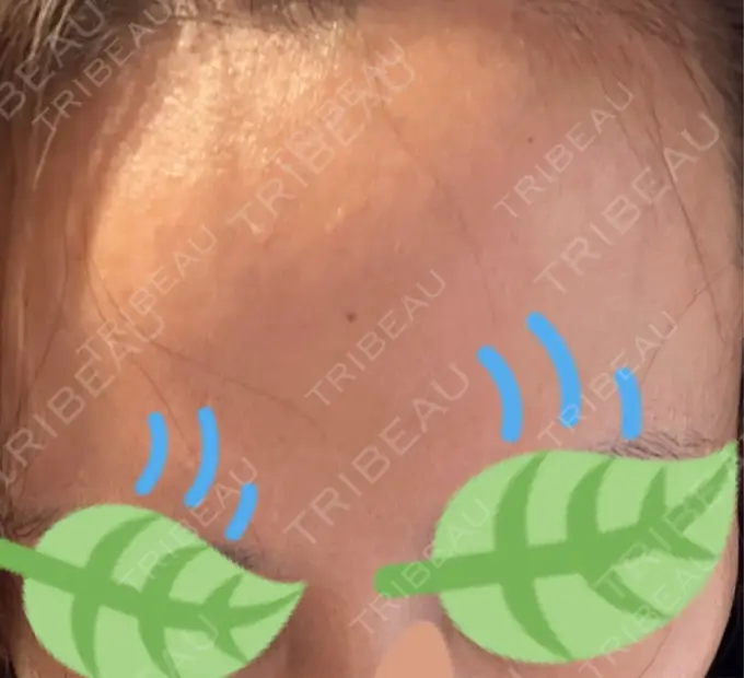 その他（肌） / エレクトロポレーション 品川美容外科 心斎橋院 DAY 3 メイン用