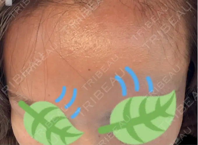 その他（肌） / エレクトロポレーション 品川美容外科 心斎橋院 DAY 4 メイン用