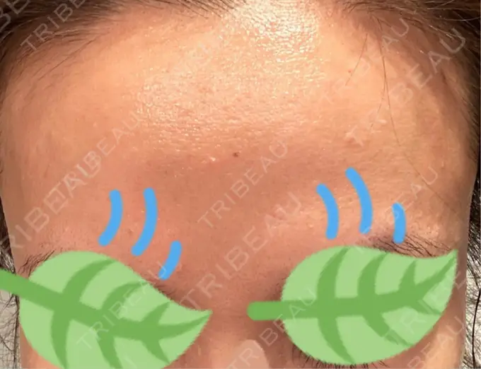 その他（肌） / エレクトロポレーション 品川美容外科 心斎橋院 DAY 5 メイン用