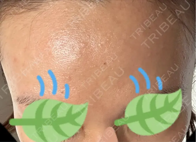 その他（肌） / エレクトロポレーション 品川美容外科 心斎橋院 DAY 6 メイン用