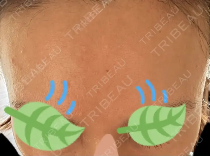 その他（肌） / エレクトロポレーション 品川美容外科 心斎橋院 DAY 7 メイン用