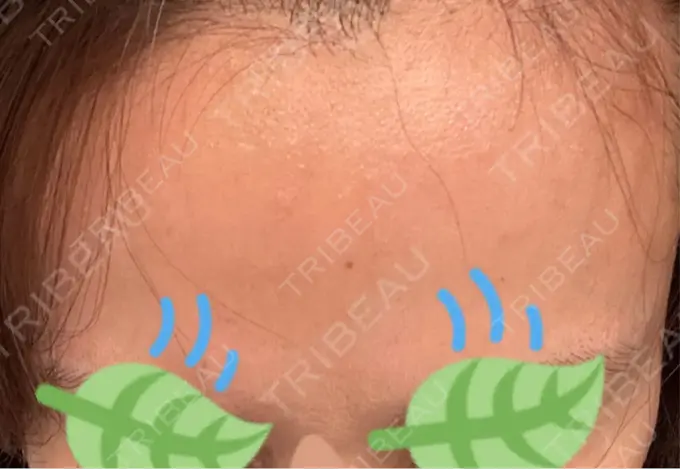 その他（肌） / エレクトロポレーション 品川美容外科 心斎橋院 DAY 8 メイン用