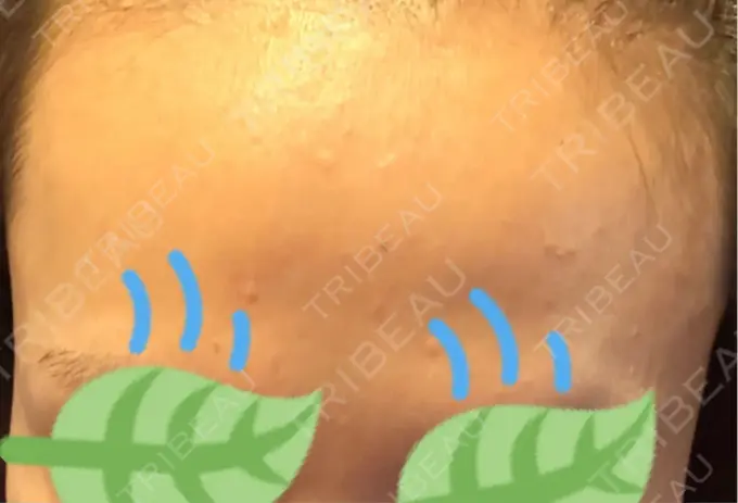 その他（肌） / エレクトロポレーション 品川美容外科 心斎橋院 DAY 9 メイン用