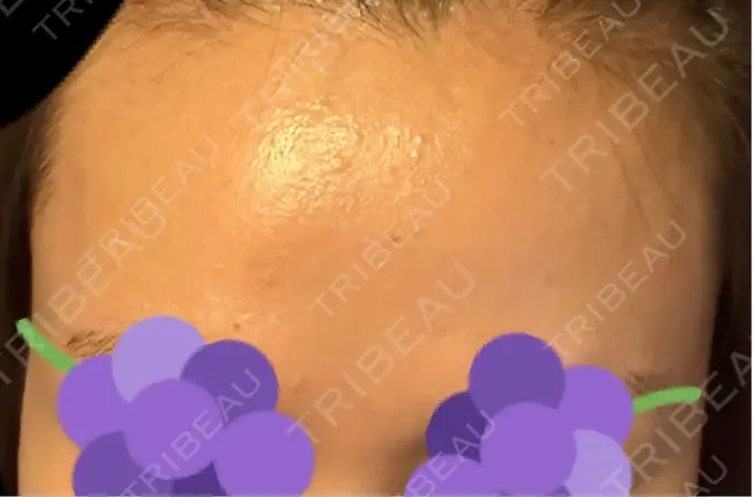 その他（肌） / エレクトロポレーション 品川美容外科 心斎橋院 AFTER メイン用