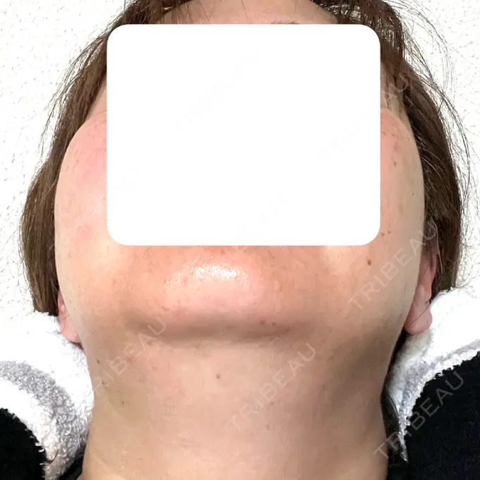 ボトックス（エラ・小顔） / 脂肪溶解注射（顔） / 脂肪溶解注射（お腹） Jfeel（ジェイフィール）クリニック-ホンデ院 DAY 2 メイン用