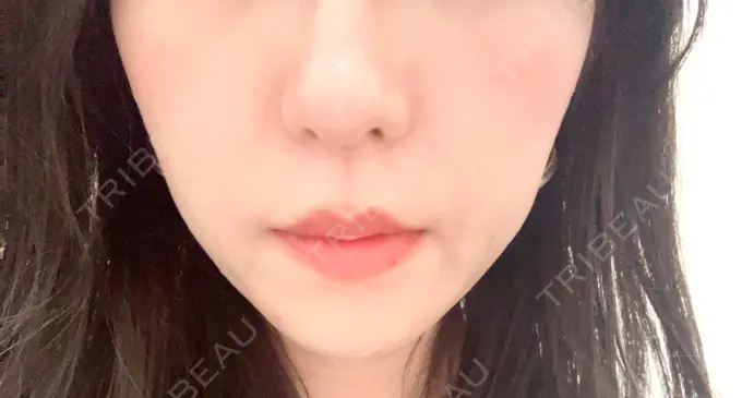 医療脱毛（顔） 共立美容外科 福岡院 AFTER メイン用