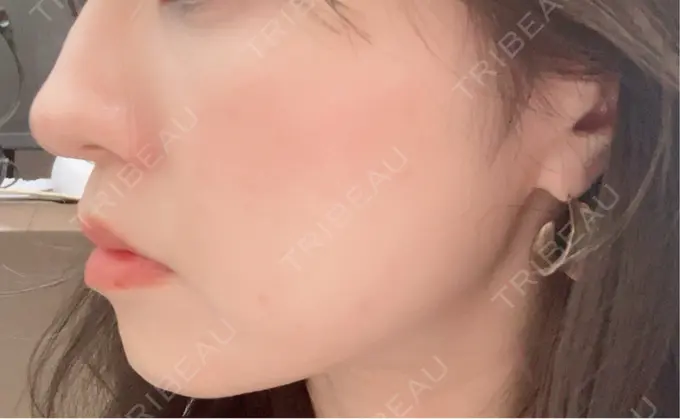 医療脱毛（顔） 共立美容外科 福岡院 DAY 0 メイン用