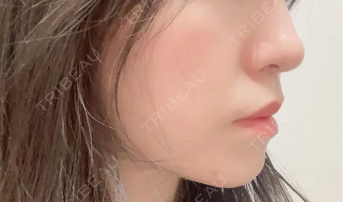 医療脱毛（顔） 共立美容外科 福岡院 DAY 0 メイン用