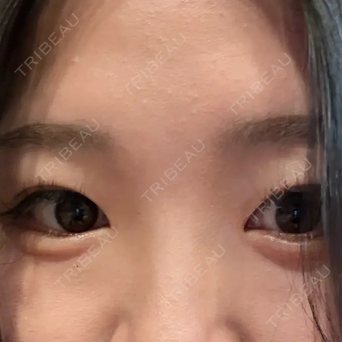 ヒアルロン酸注入（涙袋） ルラ美容クリニック 大宮院 / ルラスキンクリニック 大宮院 AFTER メイン用