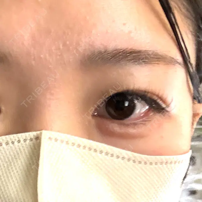 ヒアルロン酸注入（涙袋） ルラ美容クリニック 大宮院 / ルラスキンクリニック 大宮院 DAY 1 メイン用