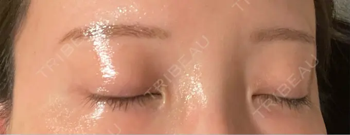 アートメイク（眉） design beauty clinic 梅田本院 DAY 2 メイン用