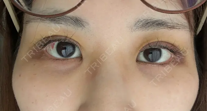 二重埋没 WOM CLINIC GINZA （ワム クリニック ギンザ） DAY 4 メイン用