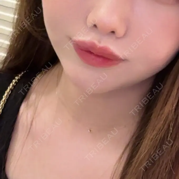 糸リフト / 脂肪吸引（顔） / 脂肪吸引（二の腕） / 脂肪吸引（脚） / 脂肪吸引（お腹） / 脂肪吸引（お尻） / 脂肪吸引（腰） / 脂肪吸引（背中） / 脂肪吸引（肩） ヴェルトラクリニック 新宿院 AFTER メイン用