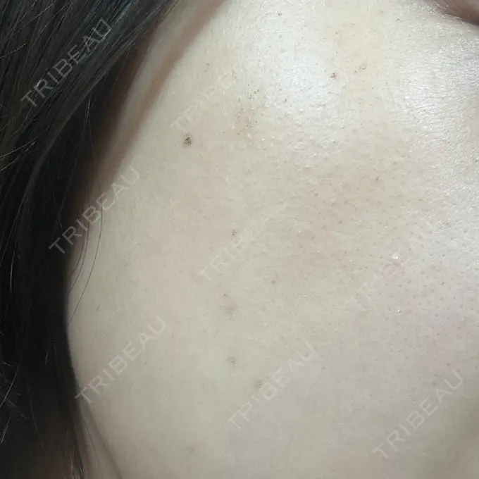 ピーリング（ハリ・ツヤ） / ルメッカ BITO BEAUTY CLINIC DAY 11 メイン用