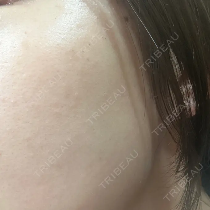 ピーリング（ハリ・ツヤ） / ルメッカ BITO BEAUTY CLINIC DAY 11 メイン用