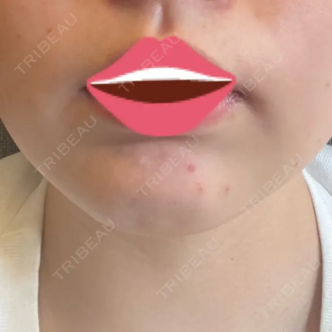 光治療（フォトフェイシャルなど） トラスト美容クリニック 銀座院 DAY 2 メイン用