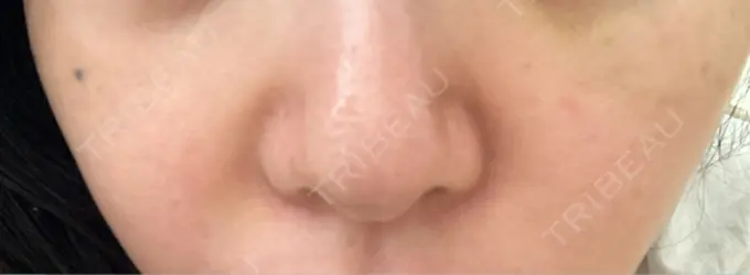 ヒアルロン酸注入（目の下） / ヒアルロン酸注入（鼻翼基部） 湘南美容クリニック 博多院 DAY 5 メイン用