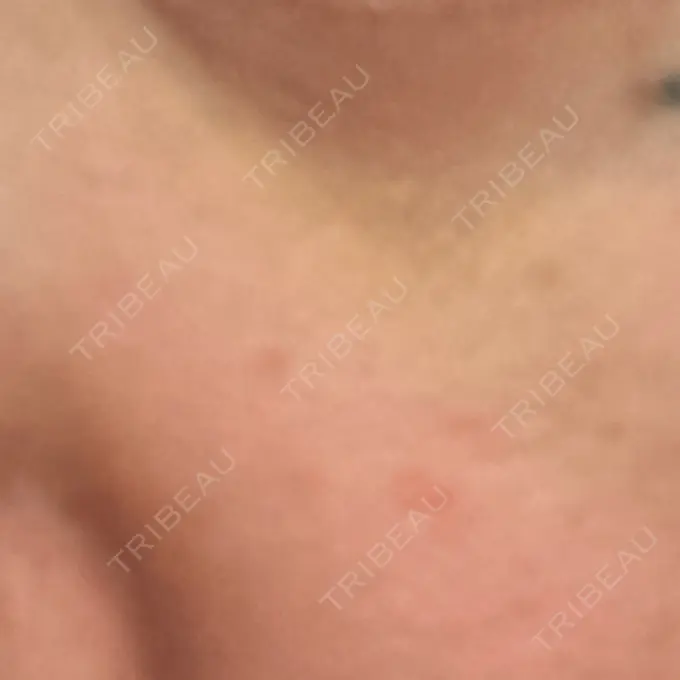 ヒアルロン酸注入（目の下） / ヒアルロン酸注入（鼻翼基部） 湘南美容クリニック 博多院 DAY 5 メイン用