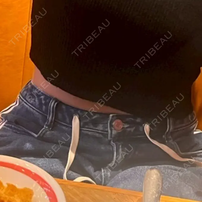 脂肪吸引（お腹） / 医療痩身（お腹） 4Dクリニック AFTER メイン用