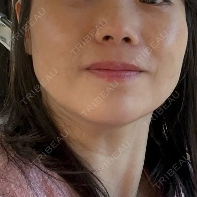 肌育注射（ジュベルックなど） ゆきスキンクリニック 東池袋 DAY 1 メイン用