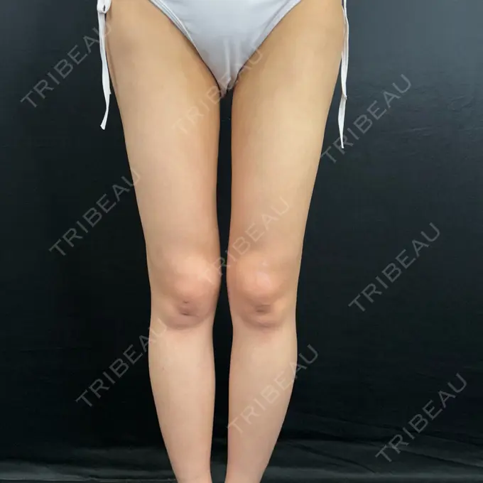 脂肪吸引（脚） / 脂肪吸引（お腹） / 豊胸（脂肪注入） / 脂肪吸引（腰） 藤・ナチュレ美容クリニック 銀座院 DAY 88 メイン用