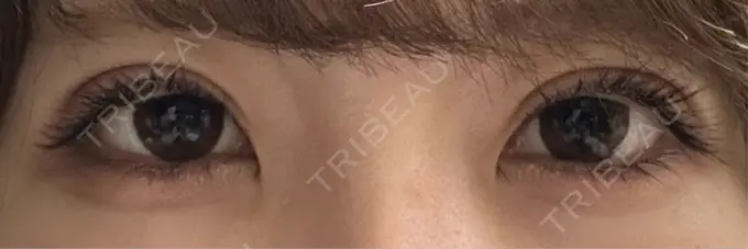 二重埋没 アリエル美容クリニック 水戸院 AFTER メイン用