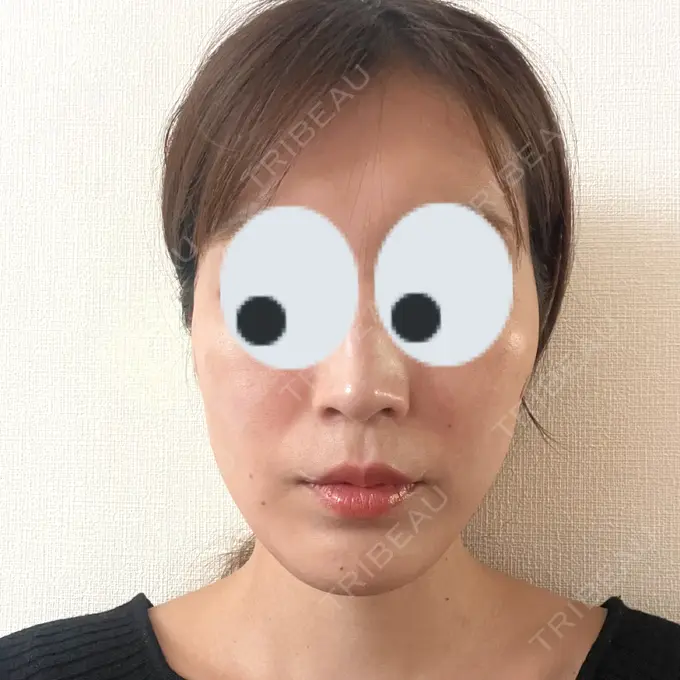 糸リフト 下北沢スキンクリニック DAY 0 メイン用