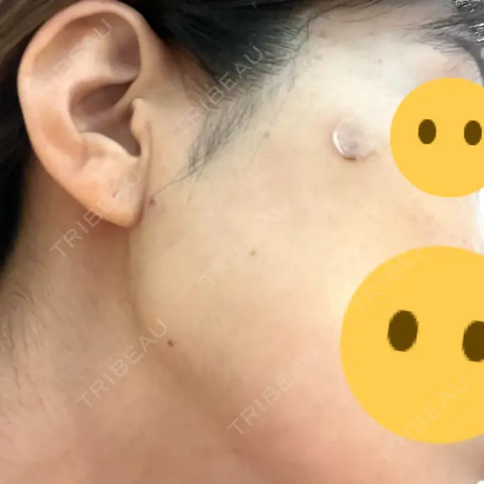 糸リフト 下北沢スキンクリニック DAY 0 メイン用