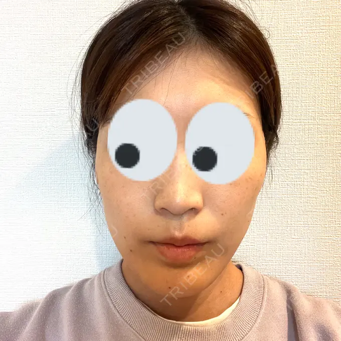 糸リフト 下北沢スキンクリニック DAY 1 メイン用