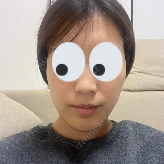 糸リフト 下北沢スキンクリニック DAY 2 メイン用