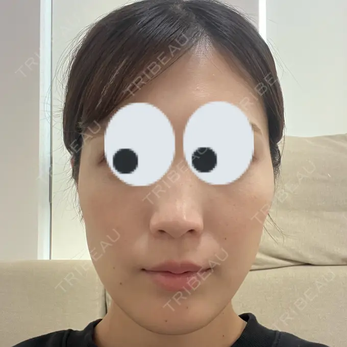 糸リフト 下北沢スキンクリニック AFTER メイン用