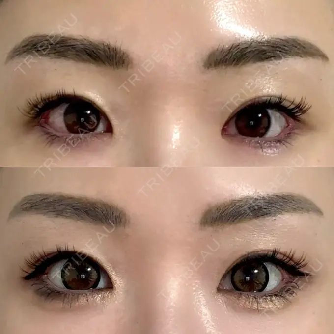 目尻切開 / タレ目形成・グラマラスライン（埋没） LOUIS CLINIC 二子玉川院【ルイクリニック】 DAY 7 メイン用