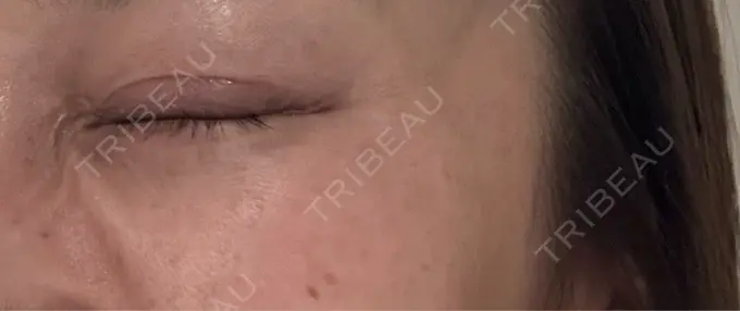 ボトックス（目尻） 札幌TAクリニック DAY 8 メイン用