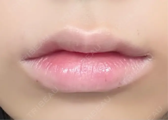 ヒアルロン酸注入（唇） / ボトックス（口角） ルラ美容クリニック 大阪心斎橋院 DAY 0 メイン用