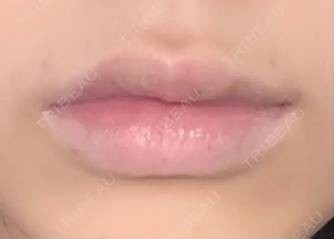 ヒアルロン酸注入（唇） / ボトックス（口角） ルラ美容クリニック 大阪心斎橋院 AFTER メイン用