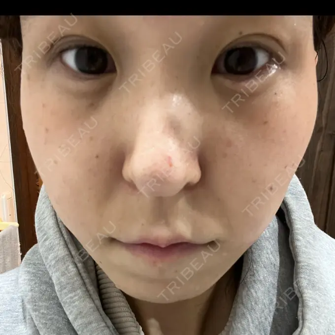 ヒアルロン酸注入（涙袋） フィラークリニック 名古屋栄院 DAY 1 メイン用