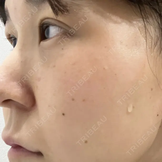 ヒアルロン酸注入（涙袋） フィラークリニック 名古屋栄院 DAY 1 メイン用