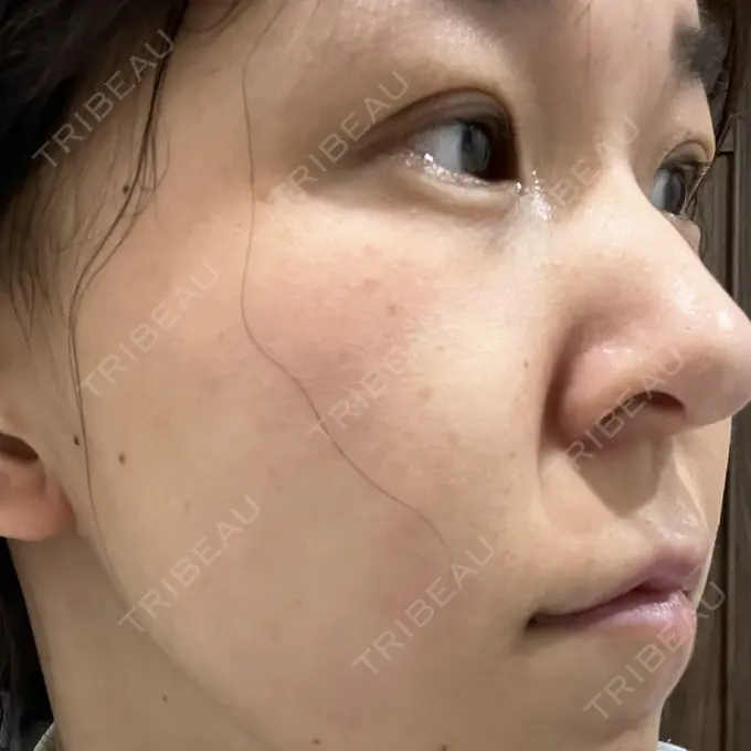 ヒアルロン酸注入（涙袋） フィラークリニック 名古屋栄院 DAY 2 メイン用