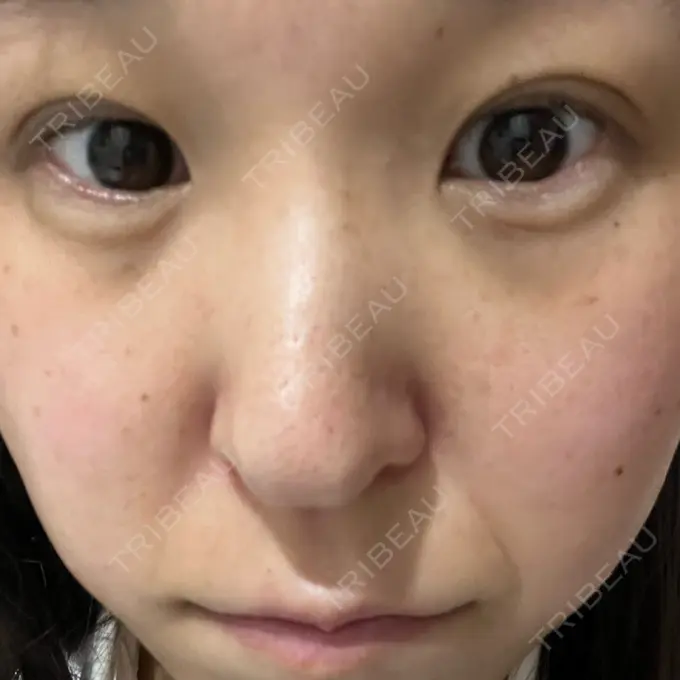 ヒアルロン酸注入（涙袋） フィラークリニック 名古屋栄院 AFTER メイン用