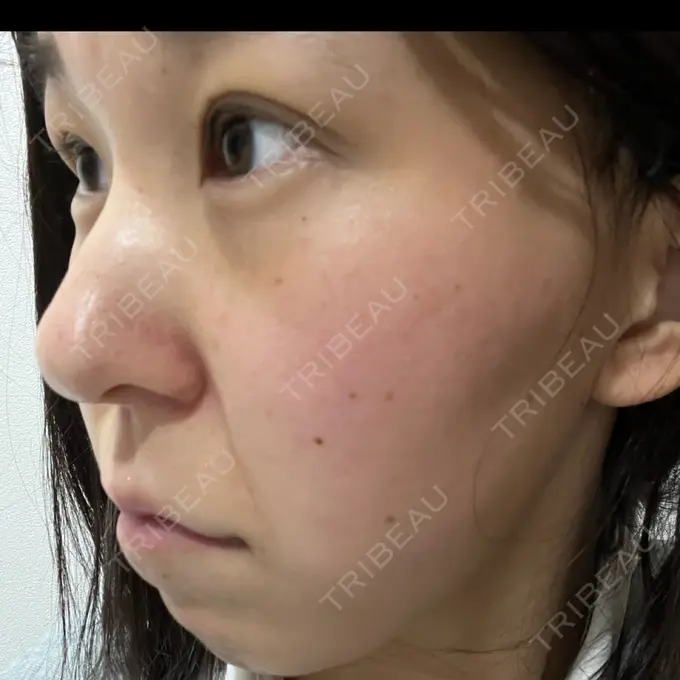 ヒアルロン酸注入（涙袋） フィラークリニック 名古屋栄院 DAY 3 メイン用